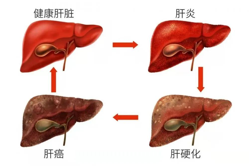 肝癌早期几乎没症状，如何预防或早期发现？